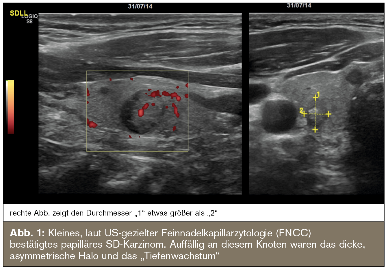 Zufallsbefund Schilddrüsenknoten I: Sonografischer Knoten – was tun ...